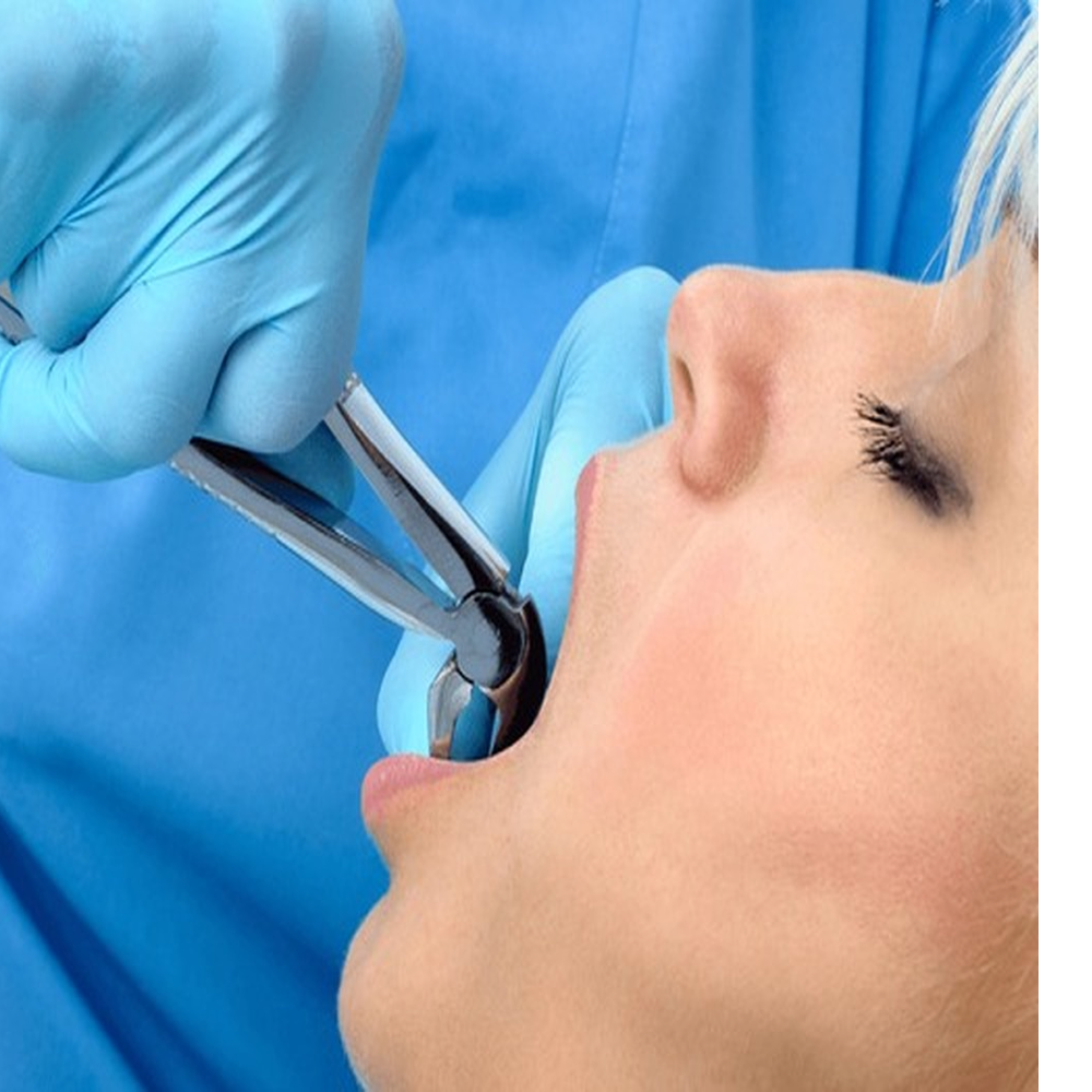 خلع الأسنان الحالات البسيطة